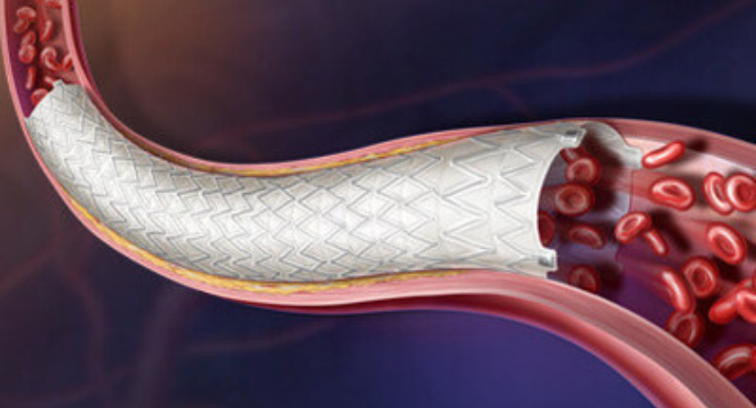 BD Secures European Approval for Iliac Artery Stent Treatment